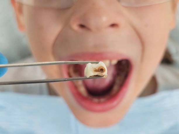 Best Emergency Dentist for Knocked-Out Tooth in Lake Placid, NY